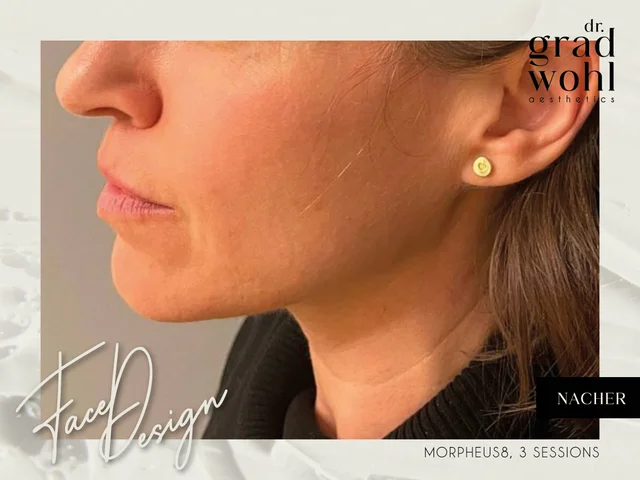 Gesichtsstraffung, Jawline Contouring - Nachher