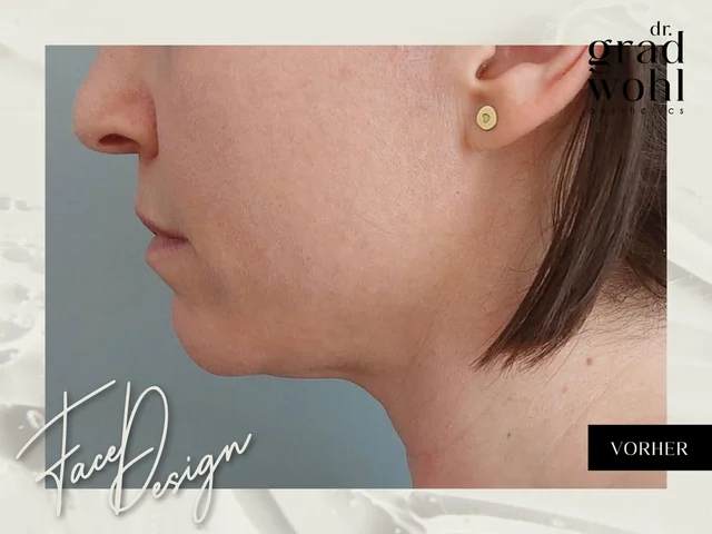 Gesichtsstraffung, Jawline Contouring - Vorher