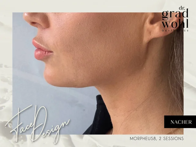 Jawline Contouring, kleines Doppelkinn - Nachher